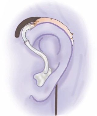 Image shows part of a hearing aid device