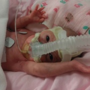 Olivia Edwards on a CPAP machine