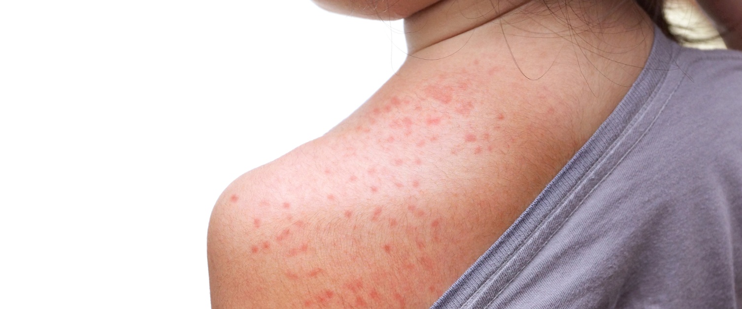 An image of a child showing their measles rash on their shoulder.