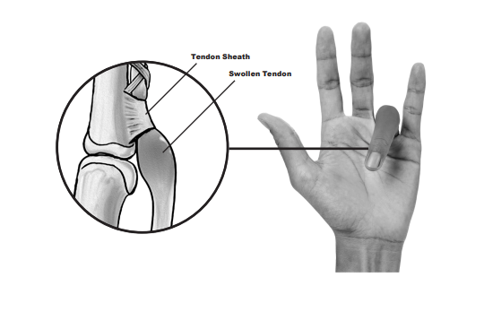 trigger finger( thumb) a vállízület kezelésének ízületének kiterjesztése