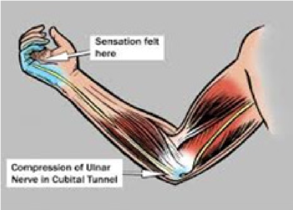 ULNAR NERVE INJURY ,CAUSES ,SYMPTOMS ,DIAGNOSIS AND TREATMENT. Cubital  tunnel syndrome. 