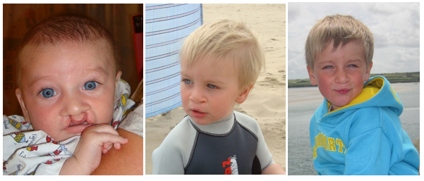 Left image of a baby boy born with a bilateral cleft lip and palate, middle image of this boy born, 1-year post surgery; right image of this boy at age 3