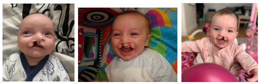 Left image of a baby boy born with a unilateral cleft lip and palate, middle image of a baby boy born with a bilateral cleft lip and palate; right image of a baby girl born with a unilateral cleft lip and palate
