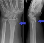 Wrist fracture photo bigger.png