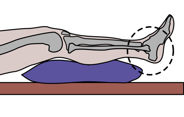 Image shows graphic of patient