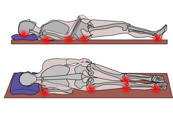 Image shows graphic of patient lying on back and lying on side.