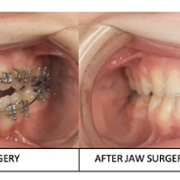 before and after jaw surgery photo9.png