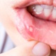 Image is a close up of a bottom lip with an ulcer on.