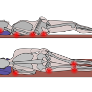 Pressure ulcer lying down