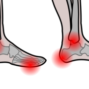 Pressure ulcer feet