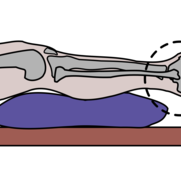 Pressure ulcer heel offloading