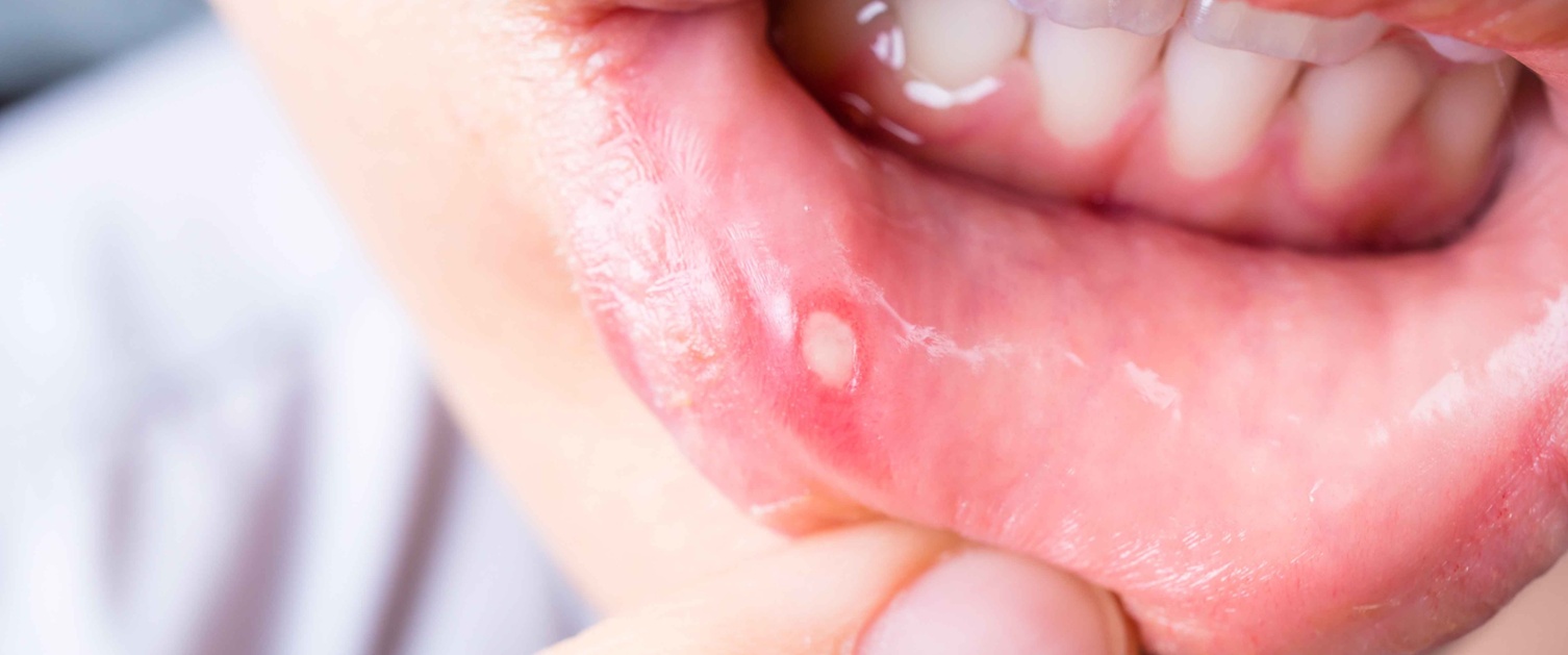 Mae delwedd yn agos i fyny o wefus gwaelod gydag wlser ymlaen.