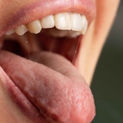 Burning mouth syndrome