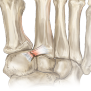 Midfoot Pain Close up.png