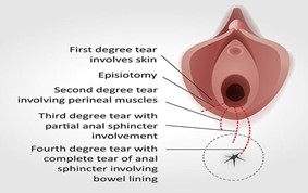 NHS 111 Wales - Health A-Z : Rectal bleeding