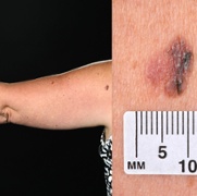 Teledermatology_arm_and_mole_original.jpg