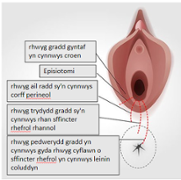 perineal tears welsh.PNG