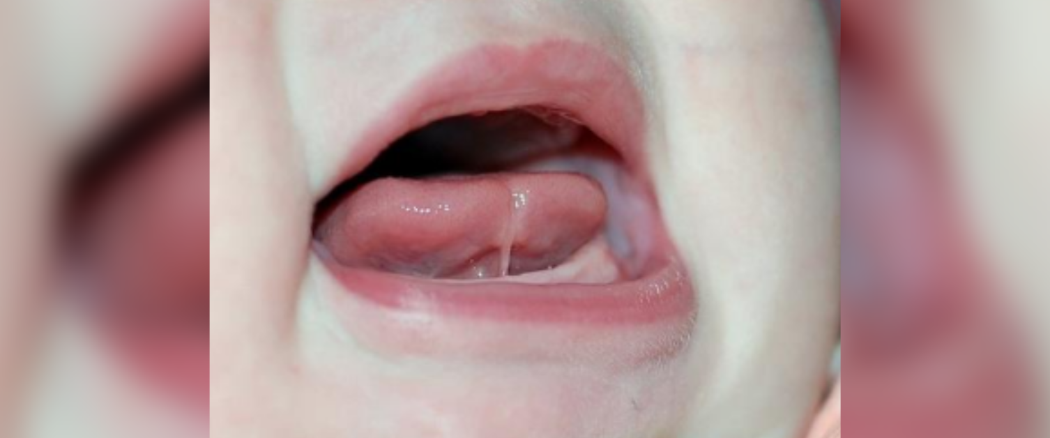 How Long Does Tongue Tie Cut Take To Heal