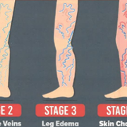 stages_vein_disease.png