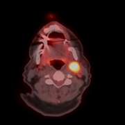 neck lump PET CT.jpg