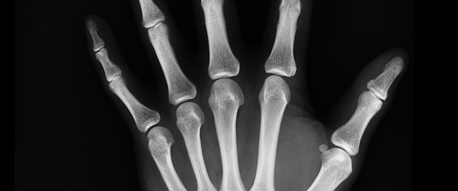 X-ray of a hand