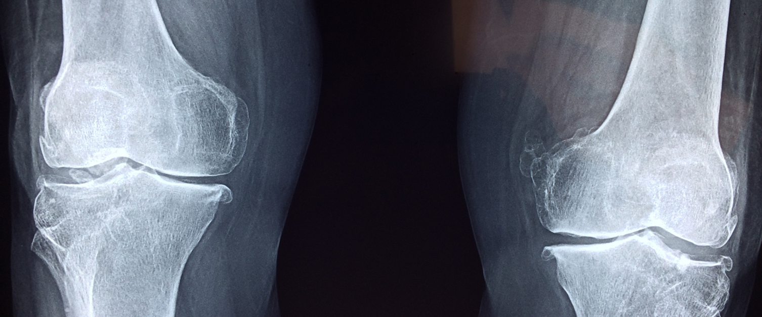 x-ray of knees