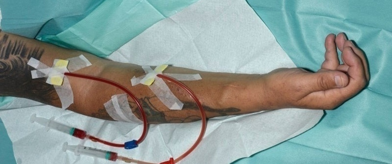 AV fistula with dialysis needles inserted