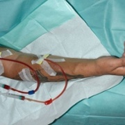 Fistula with needles