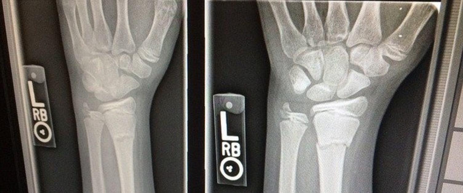 Broken wrist x-ray