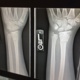 Broken wrist x-ray