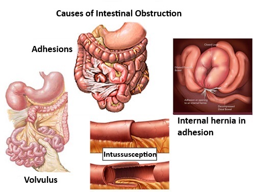Causes of Intestinal Obstruction. Adhesions. Internal hernia adhesion. Volvulus. Intussusception