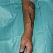 Fistula without needles