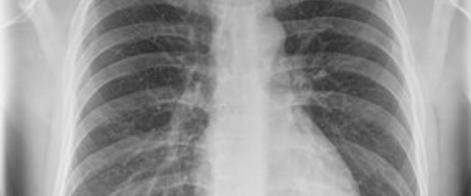 Picture of a chest X-ray