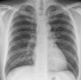 Picture of a chest X-ray