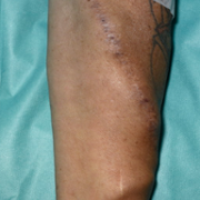AVF without needle CC.png