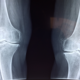 x-ray of knees