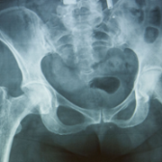 Hip fracture x ray