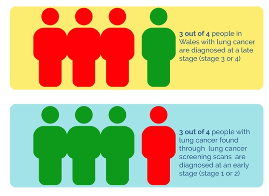 3 out of 4 people in Wales with lung cancer are diagnosed at a late stage (stage 3 or 4) 3 out of 4 people with lung cancer found through lung cancer screening scans are diagnosed at an early stage (stage 1 or 2)