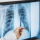 x-ray of chest