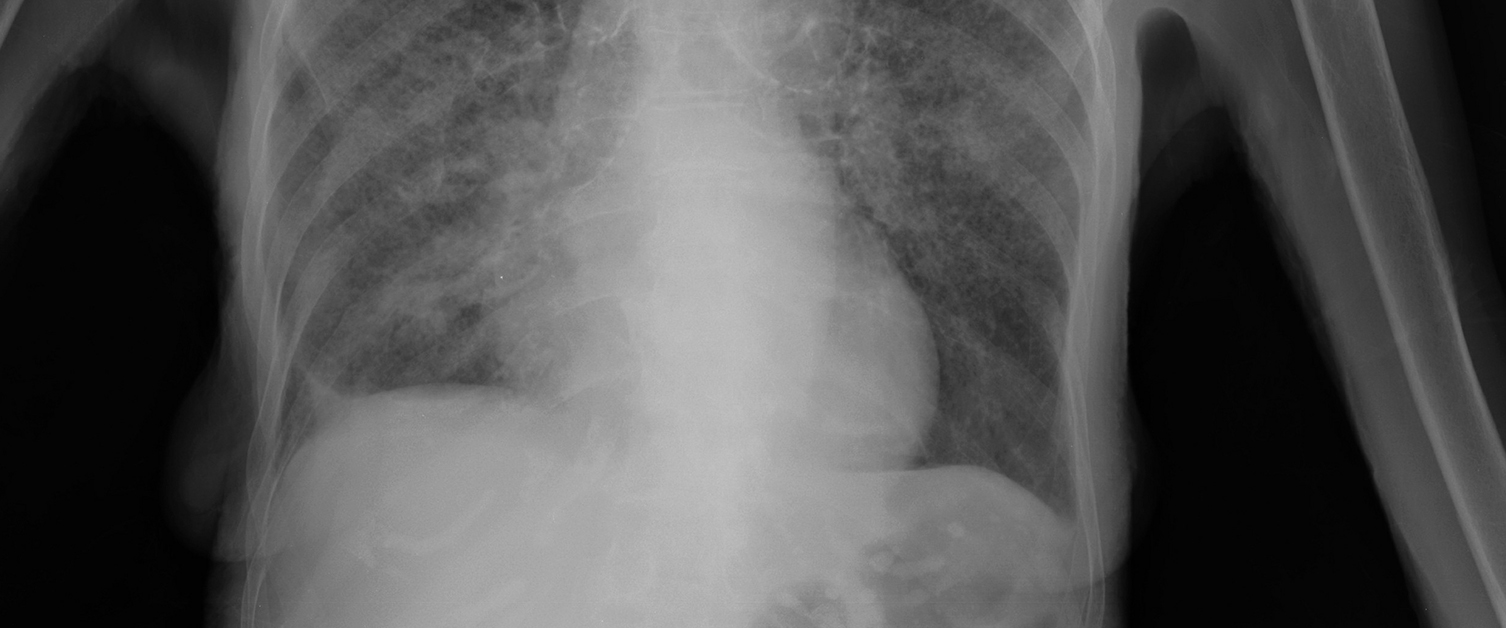 x-ray of lungs with tb