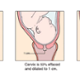 three graphics of how the cervix dilates before birth