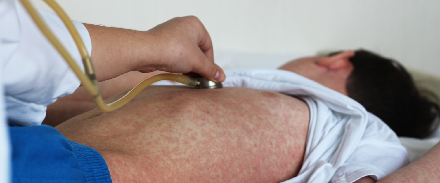 young boy with measles rash being checked by doctor