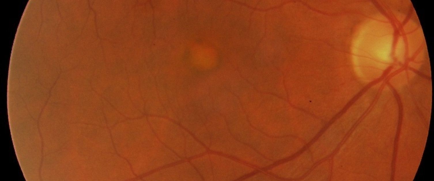 Bulls eye maculopathy