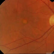 Bulls eye maculopathy image