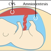 Section 7 Amniocentesis.jpg
