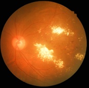 maculopathy