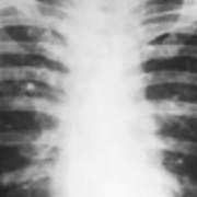 chest x ray