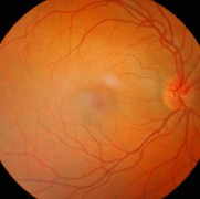 no diabetic retinopathy image