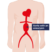 Aorta with an aneurysm