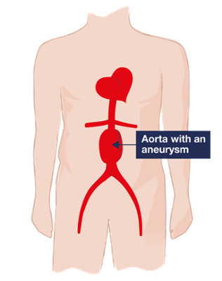 Diagram of an aorta with an aneurysm